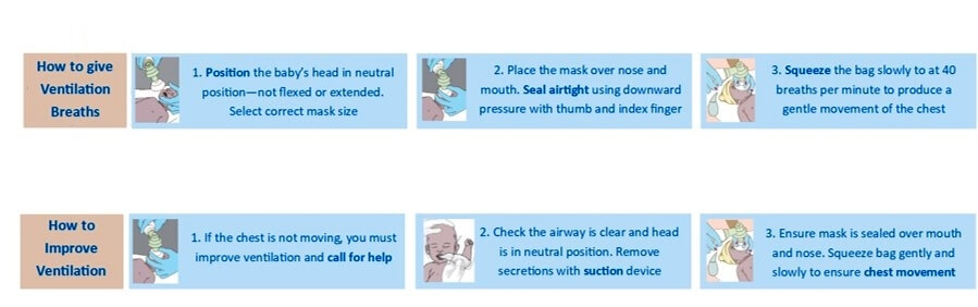 ventilate-a-baby-instructions Instructions on the BabySaver resuscitation kit